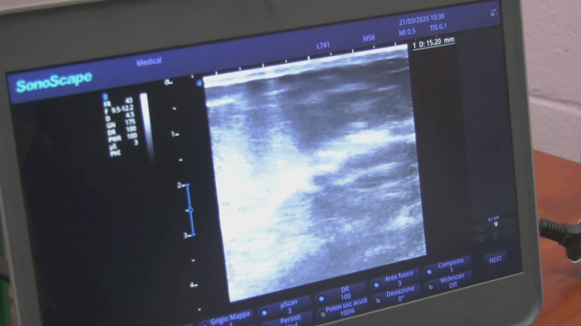 TUMORE AL SENO - "RADAR" PER INDIVIDUARE LESIONI IMPALPABILI - Video ...